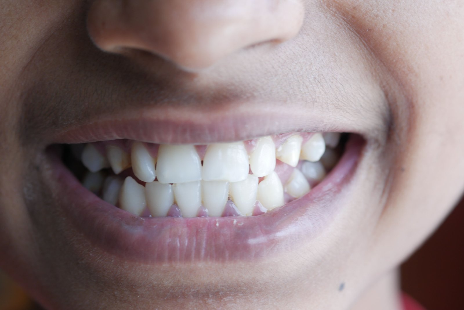 Sorriso saudável e alinhado após tratamento odontológico